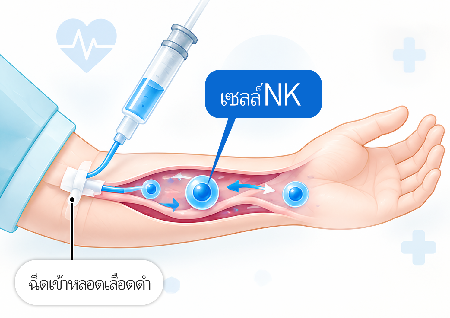 ภาพอธิบายการให้ NK เซลล์ทางหลอดเลือดดำที่แขน